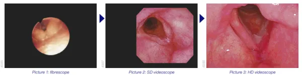 Fibroscope Olympus - 3 images.png